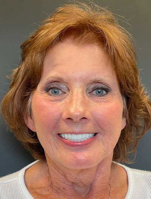 SmileHaus_Patient_07_After-3d1e25ee-1920w